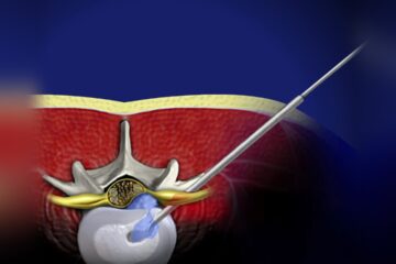 Minimally Invasive Spine Surgery