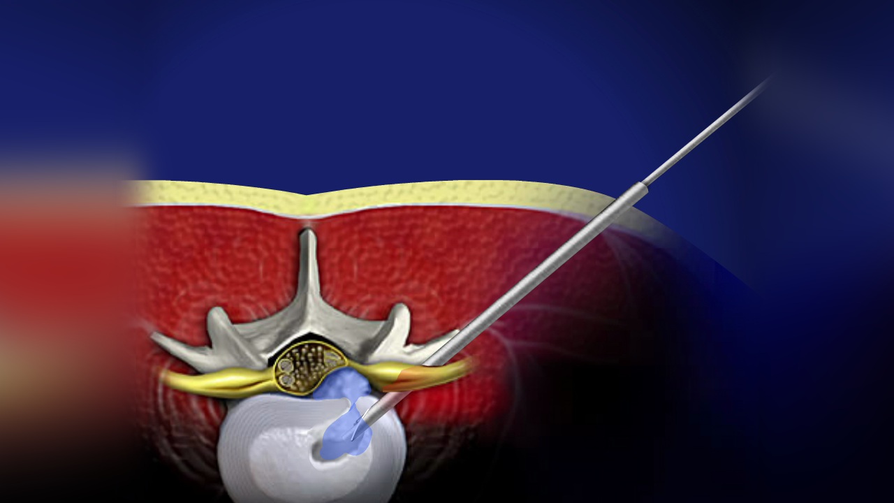 Minimally Invasive Spine Surgery