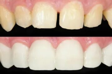 Composite Bonding Solihull: A Complete Guide to a Confident, Natural Smile