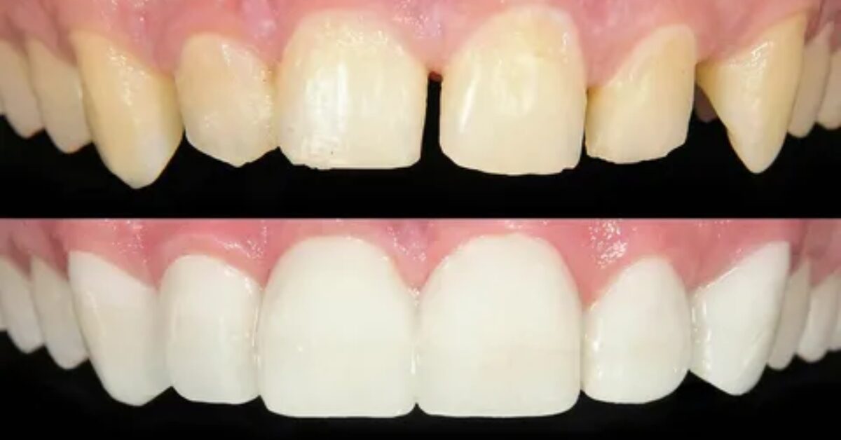 Composite Bonding Solihull: A Complete Guide to a Confident, Natural Smile