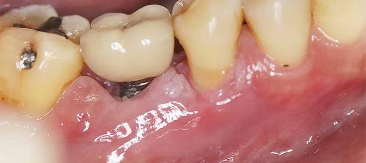 Peri-Implantitis: When Gum Disease Affects Dental Implants